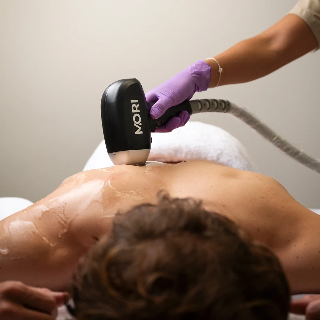 1x Bovenlichaam laserontharing (man)