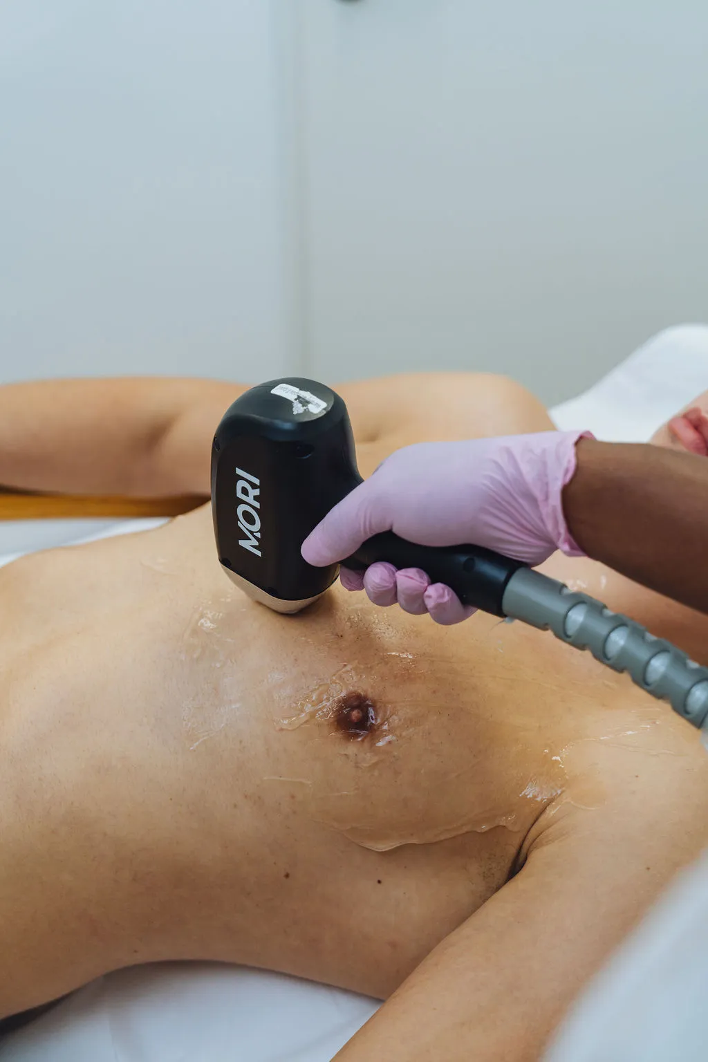 Laserbehandeling met de MORI Vision bij Gloow Ypenburg